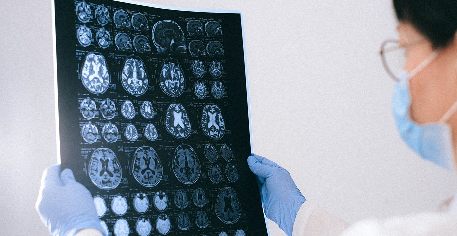 COVID Can Lead to Brain Damage and Cognitive Impairment